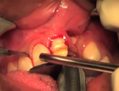 Crevicular Incision extending around the defect to reflect the mucoperiosteum