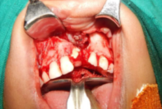 Sharp dissection to separate the nasal layer from oral layer