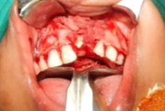 Cortico-cancellous Bone mixed with PRP, grafted into the defect.