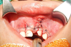 V-Y Closure increase vestibular length with water tight suturing