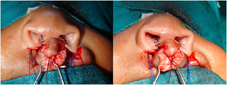 Nasal sill is closed bilaterally 