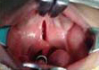 Type III a Isolated Cleft of Soft Palate