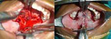 Adaption sutures placed to hold down hard palate mucosa reducing dead space. Sling sutures placed laterally