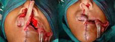 Lower lip dissection is done to raise the Abbe Flap