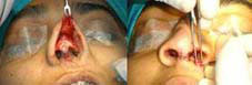 Placement of strut and wedge incision to reposition ala of nose.