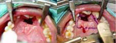  Anterior palatal fistula.