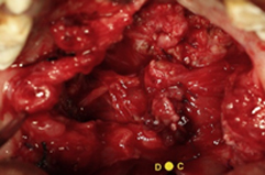  Closure of nasal layer with  Levator Myoplasty