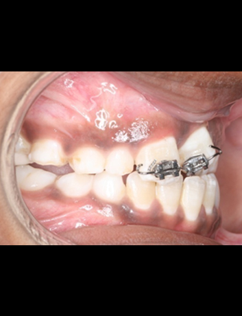 Ongoing Ortho Treatment